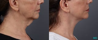 Before and after Facelift & Neck Lift case 19692 - Angle 3