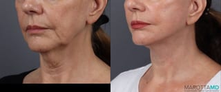 Before and after Facelift & Neck Lift case 19692 - Angle 4