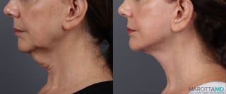 Before and after Facelift & Neck Lift case 19692 - Angle 5