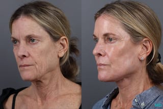 Before and after Blepharoplasty Lower case 19695 - Angle 4