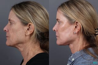 Before and after Blepharoplasty Lower case 19695 - Angle 5