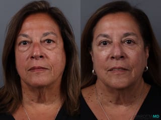 Before and after Blepharoplasty Lower case 19701 - Angle 1