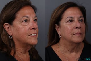 Before and after Blepharoplasty Lower case 19701 - Angle 2