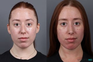 Before and after Rhinoplasty case 19923 - Angle 1