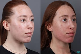 Before and after Rhinoplasty case 19923 - Angle 2