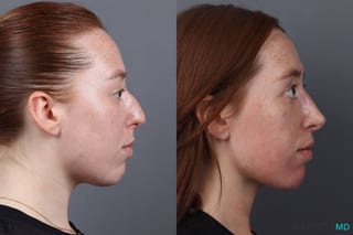 Before and after Rhinoplasty case 19923 - Angle 3
