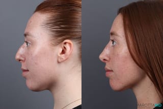 Before and after Rhinoplasty case 19923 - Angle 5