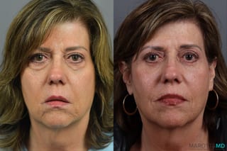 Before and after Blepharoplasty Lower case 21370 - Angle 1