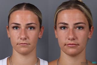Before and after Botox - Lip Flip case 21377 - Angle 2