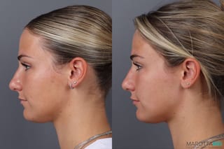 Before and after Botox - Lip Flip case 21377 - Angle 5