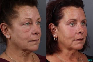 Before and after Blepharoplasty Upper case 21514 - Angle 2