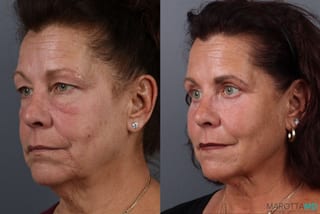 Before and after Blepharoplasty Upper case 21514 - Angle 3