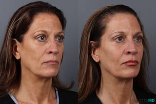Before and after Filler - Cheek case 21531 - Angle 3