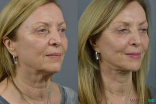 Before and after Facelift & Neck Lift case 21668 - Angle 5