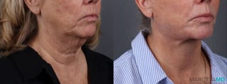 Before and after Fat Transfer - Face case 23768 - Angle 2
