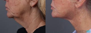 Before and after Fat Transfer - Face case 23768 - Angle 5