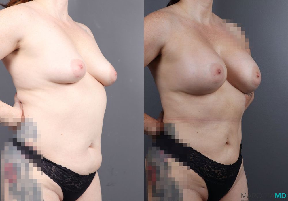 Before and after Renuvion case 7035 - Angle 6