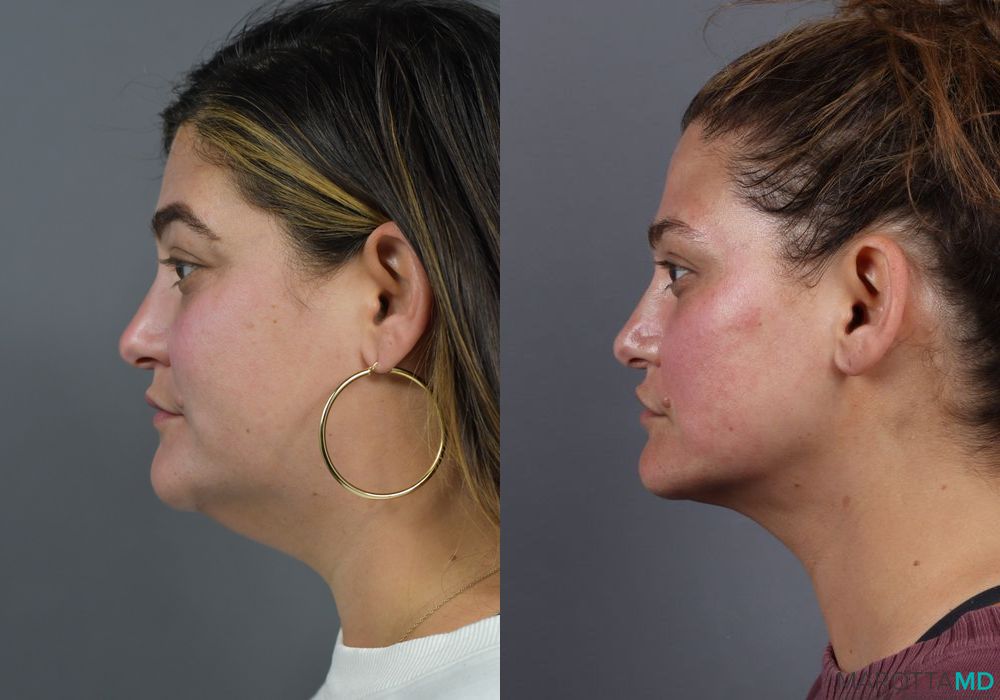 Renuvion - Thumbnail 2