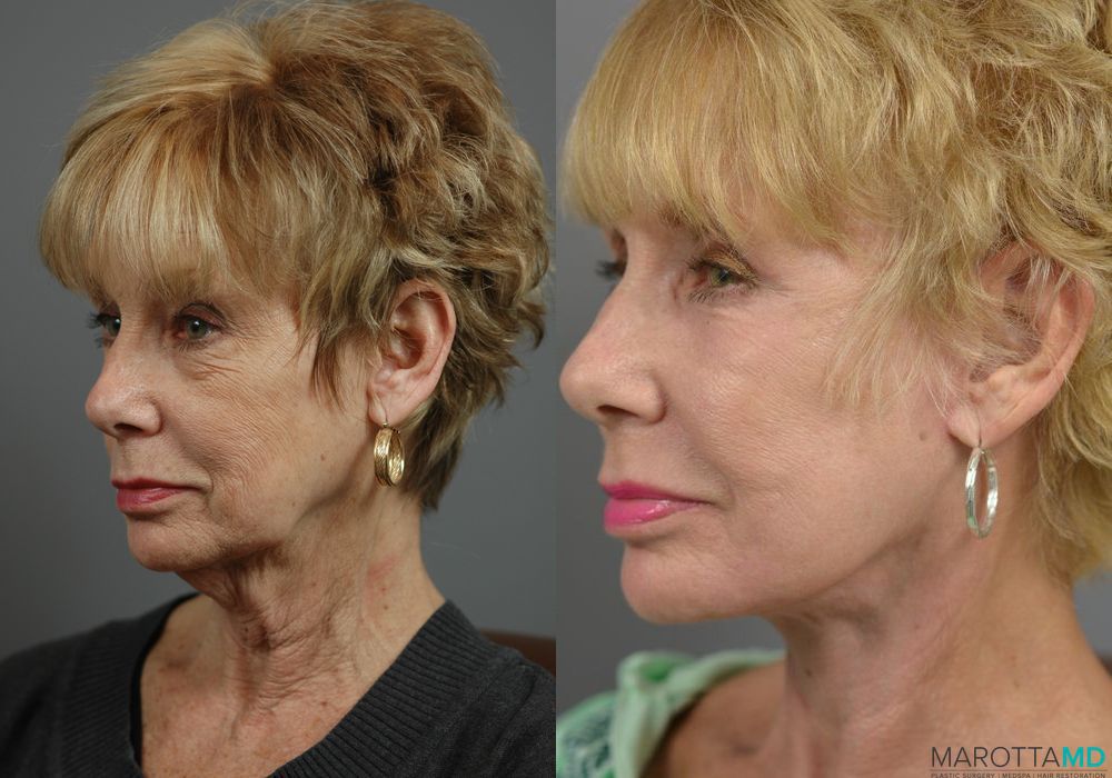 Facelift & Neck Lift - Thumbnail 4