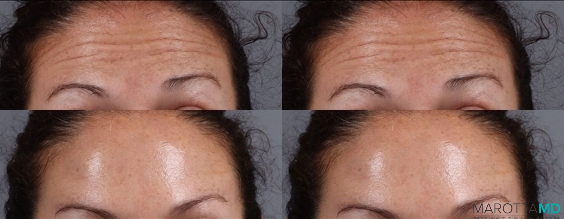 Before and after BOTOX® Cosmetic case 7191 - Angle 2