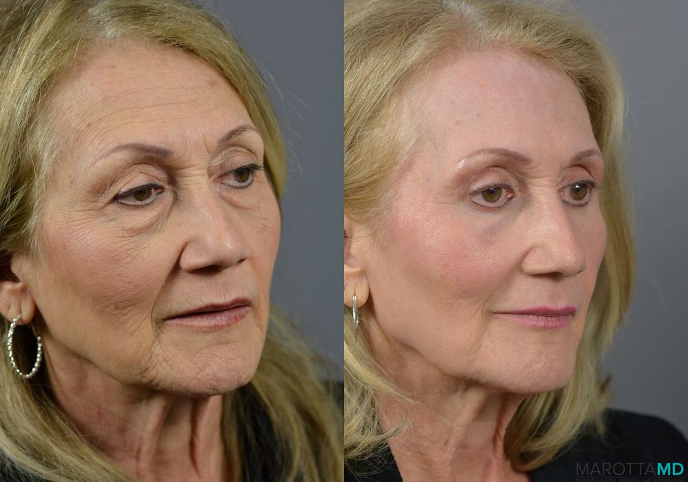 Laser Skin Resurfacing - Face - Thumbnail 4
