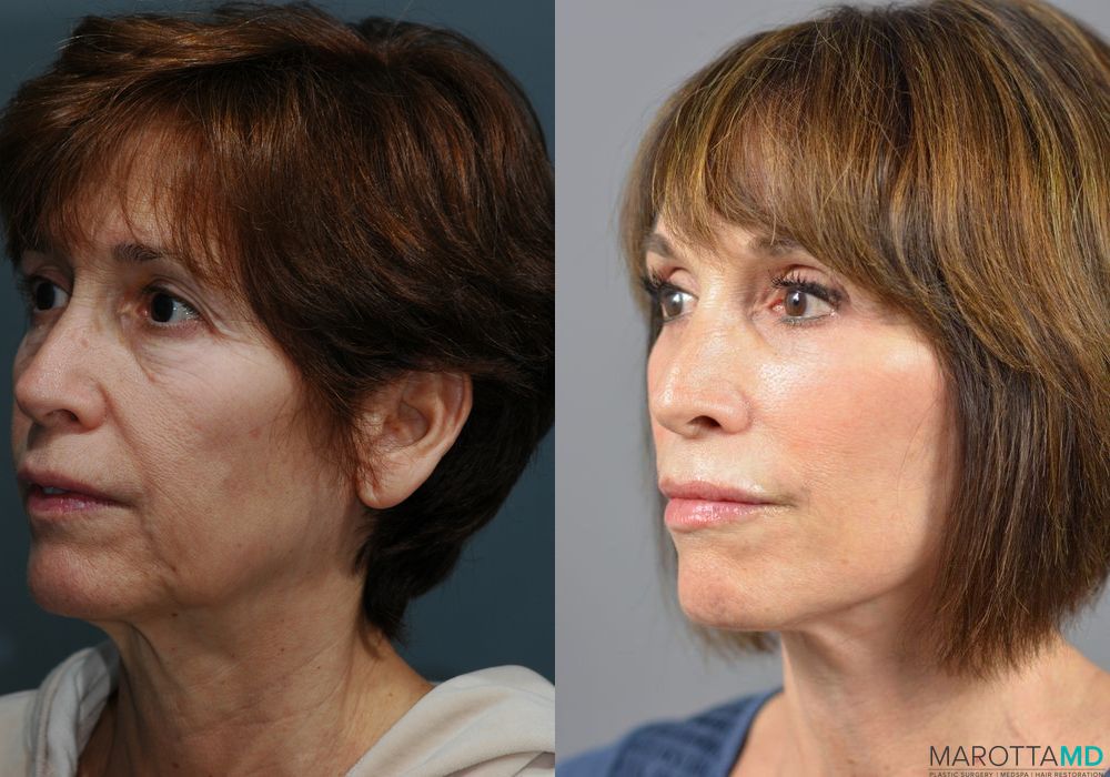 Facelift & Neck Lift - Case 195