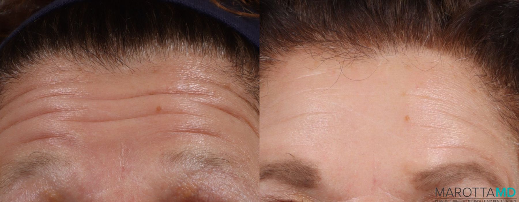 Before and after Botox - Forehead case 7169