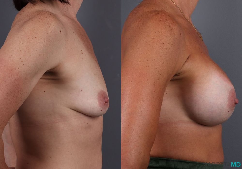 Before and after Breast Augmentation case 7083 - Angle 3