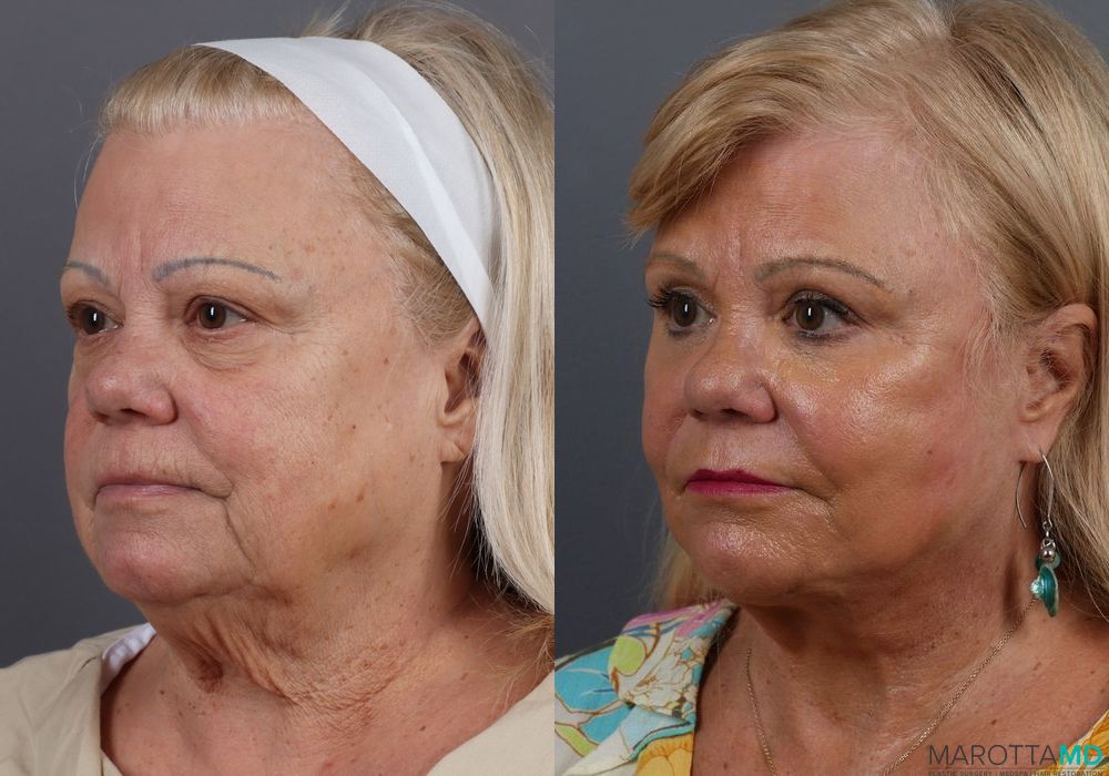 Laser Skin Resurfacing - Face - Thumbnail 3