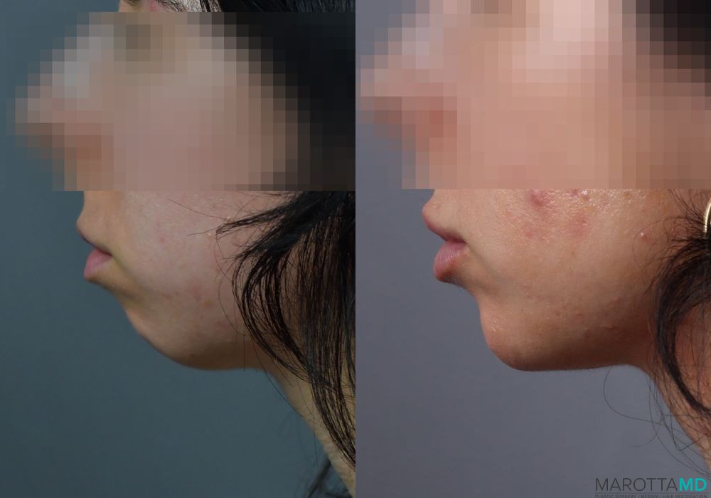 Filler - Chin - Case 389