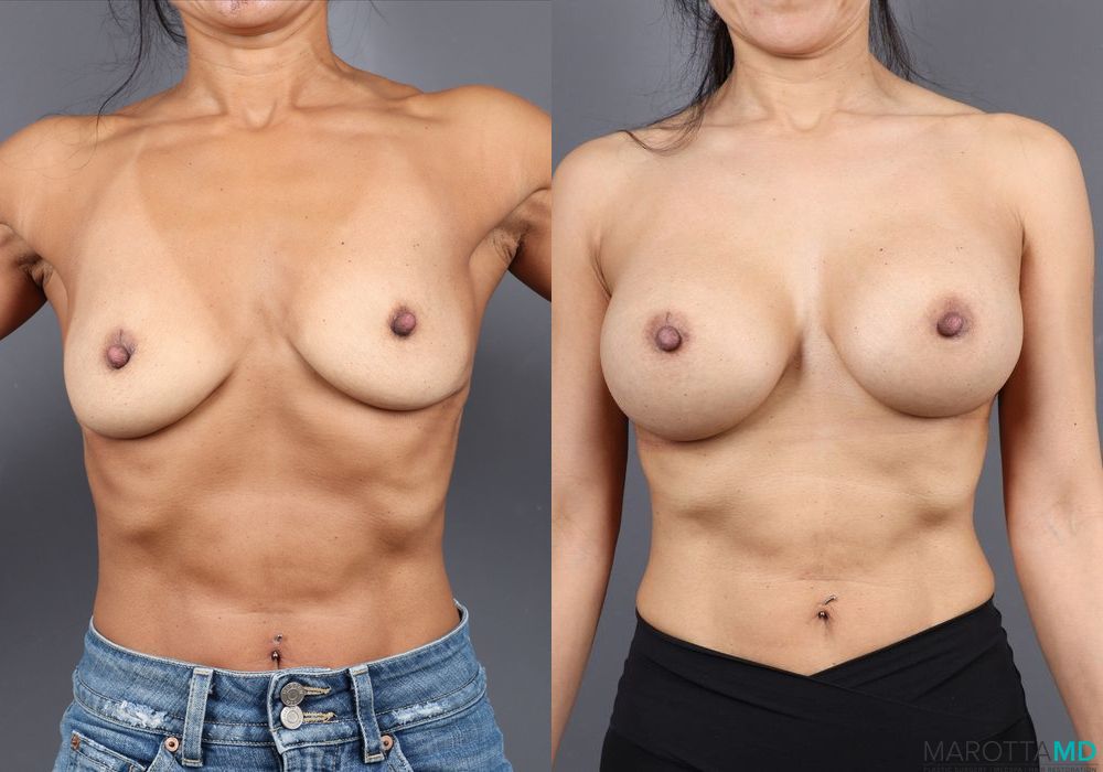Breast Augmentation - Case 128