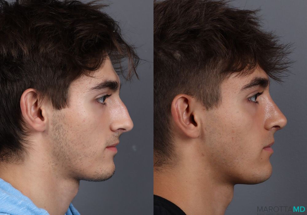 Before and after Male Rhinopolasty case 7015 - Angle 4