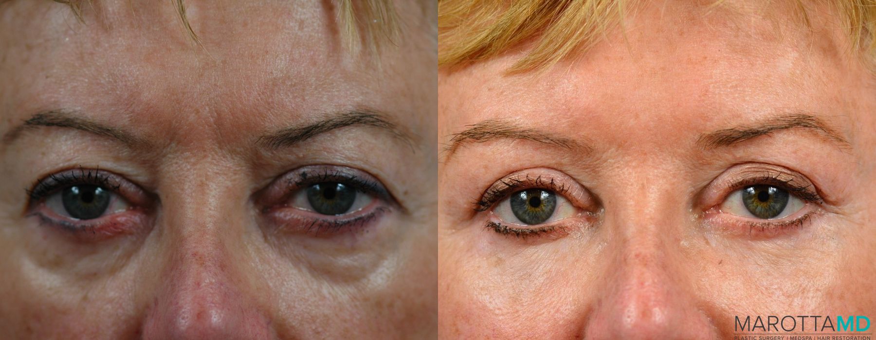 Before and after Eyelid Lift case 7253 - Angle 2