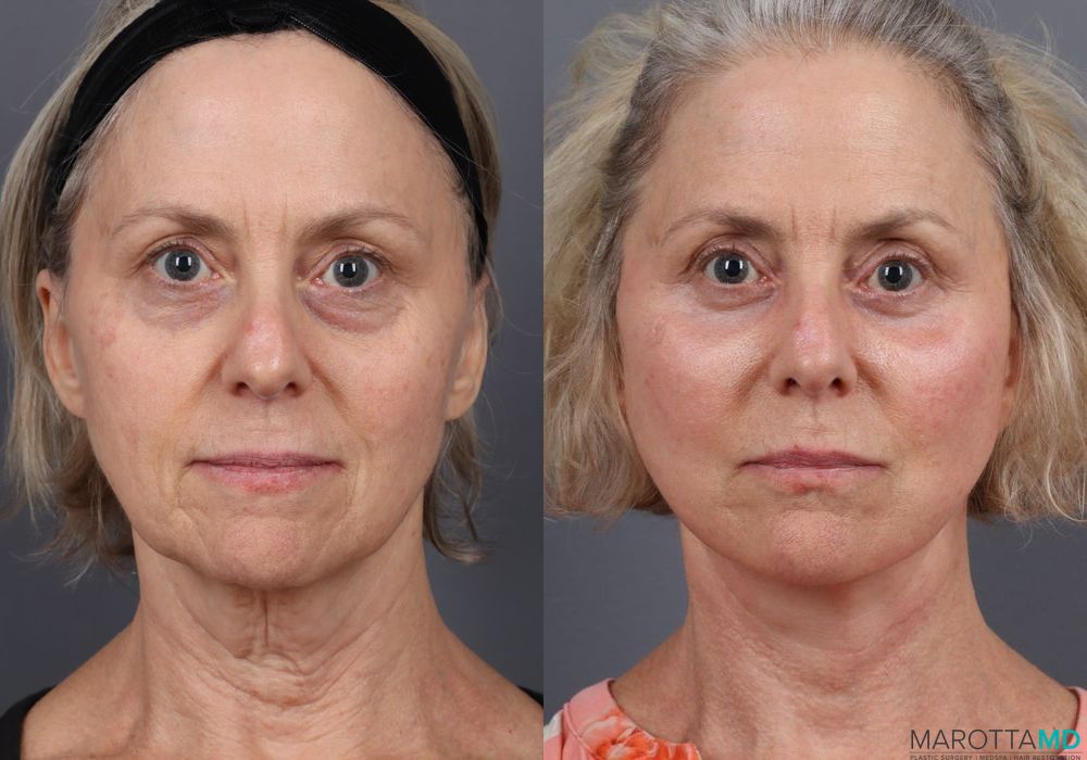 Before and after Facelift & Neck Lift case 7087