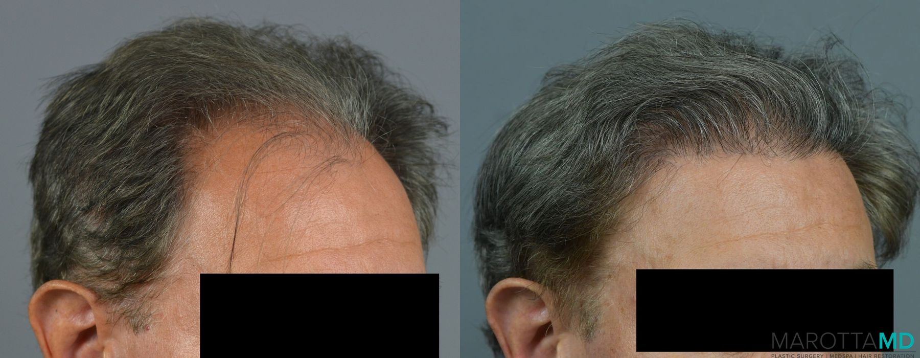 Hair Transplantation - Thumbnail 3