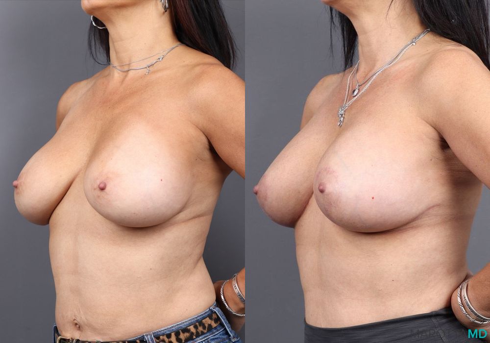 Breast Implant Exchange - Thumbnail 3