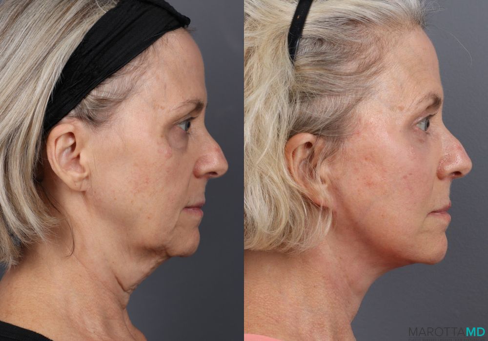 Before and after Facelift & Neck Lift case 7087 - Angle 5