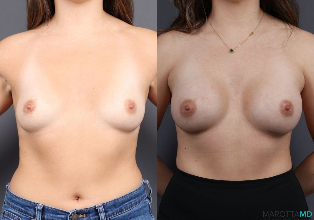 Breast Augmentation - Thumbnail 2