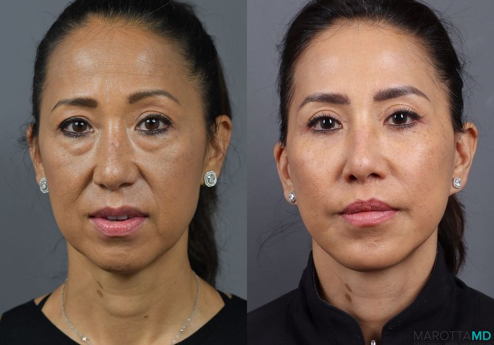 Buccal Fat Removal - Thumbnail 5