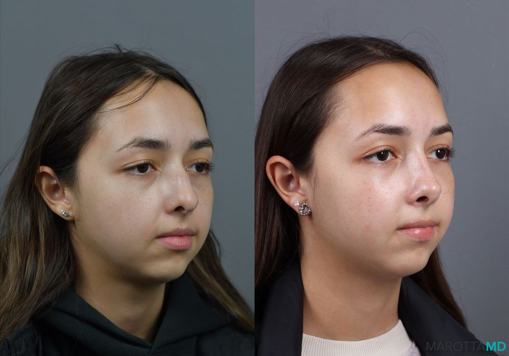 Before and after Rhinoplasty case 7279 - Angle 4