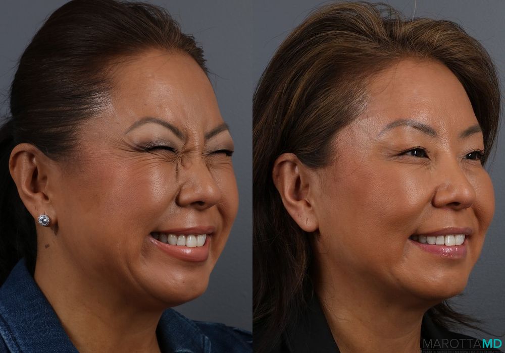 BOTOX® Cosmetic - Thumbnail 2