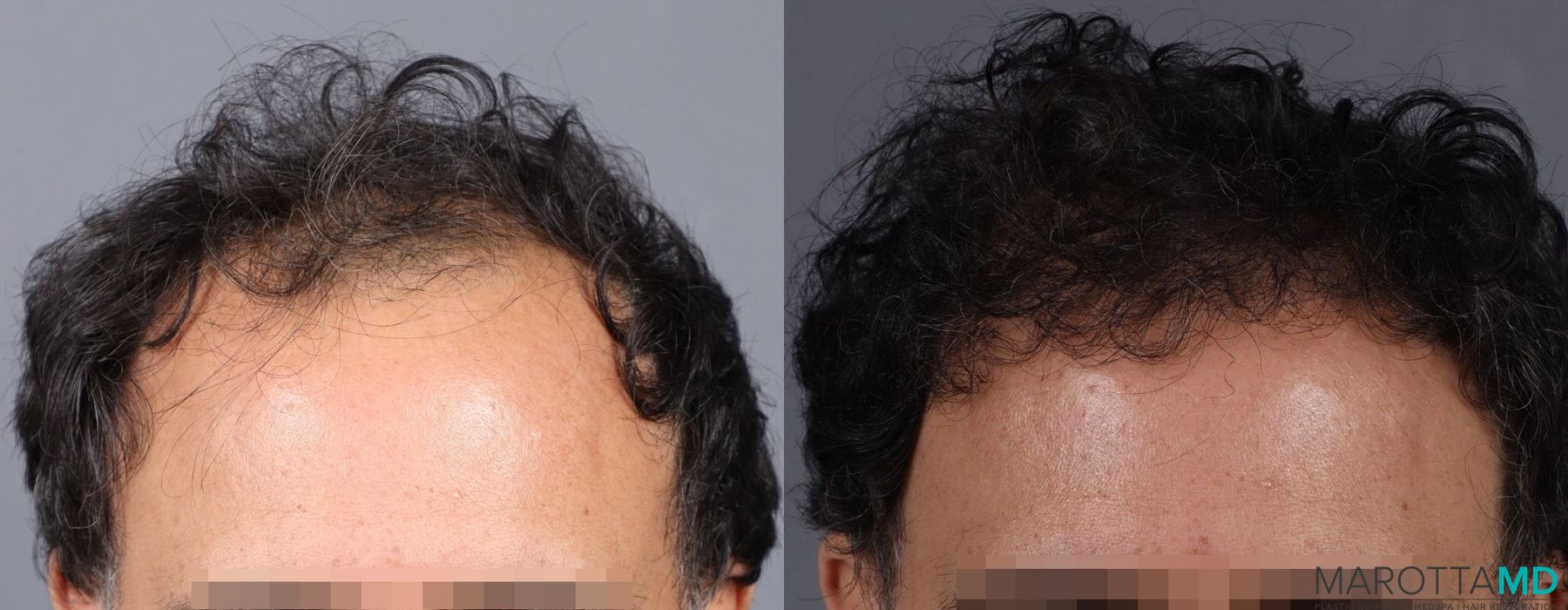 Hair Transplantation - Thumbnail 3