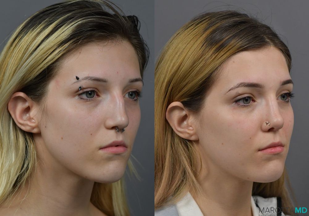 Before and after Rhinoplasty case 7257 - Angle 2