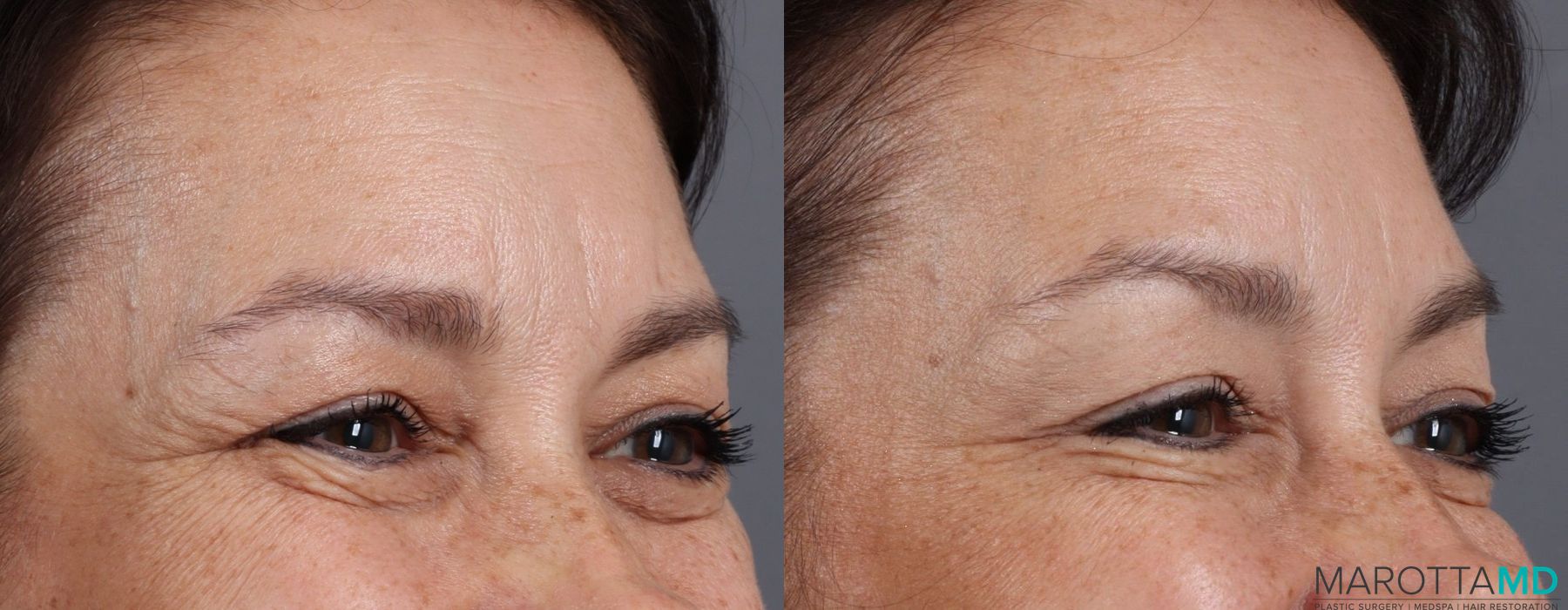 Botox - Glabella - Thumbnail 2