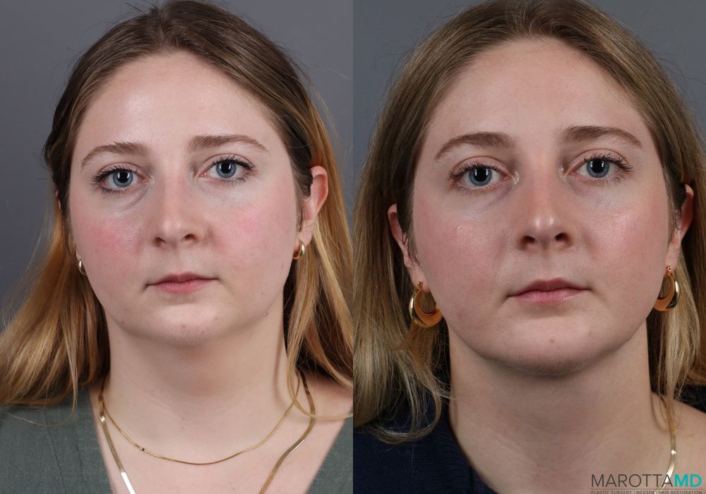 Liposuction of the Neck - Thumbnail 3