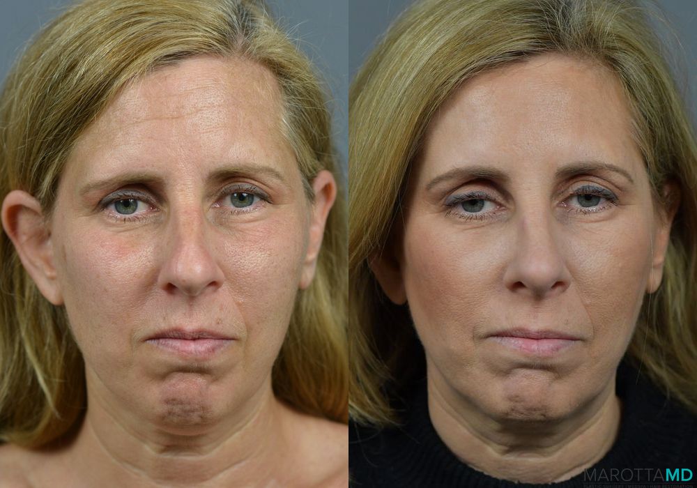 Before and after Rhinoplasty case 7203