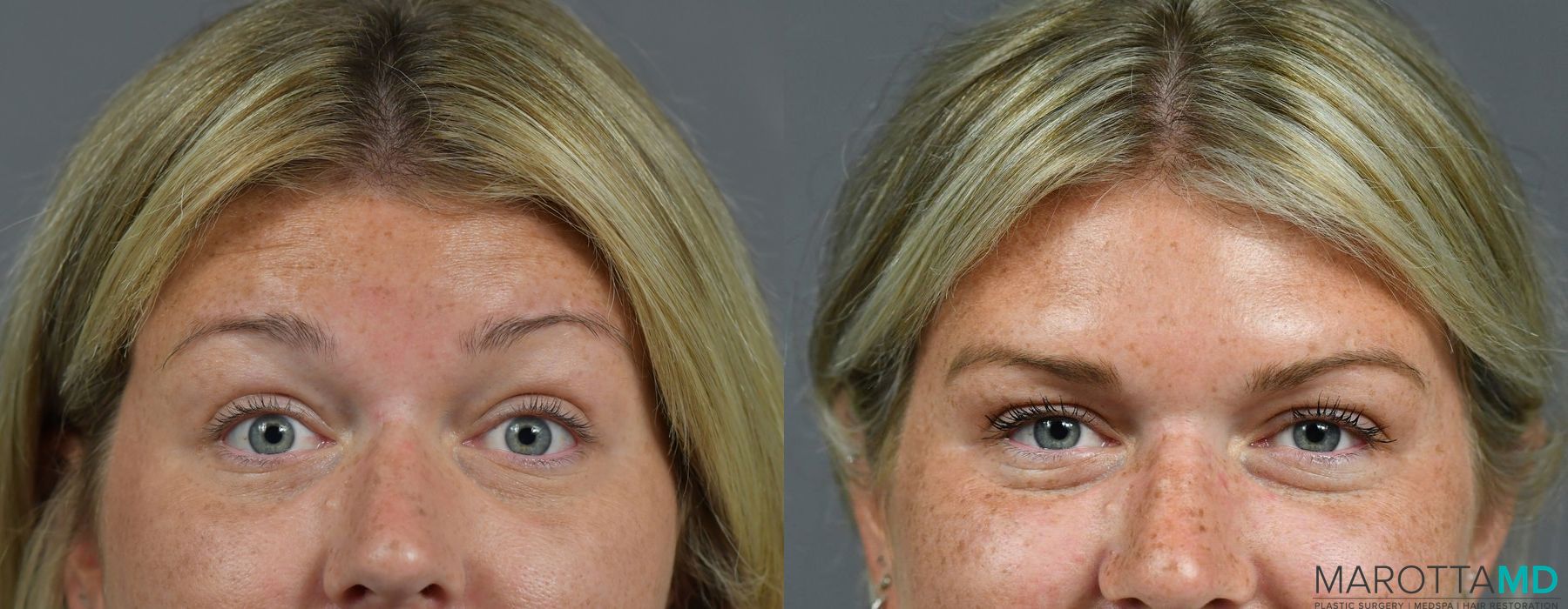 Before and after Botox - Forehead case 7184 - Angle 2