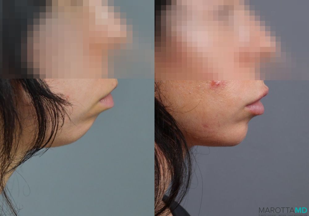 Filler - Chin - Thumbnail 2