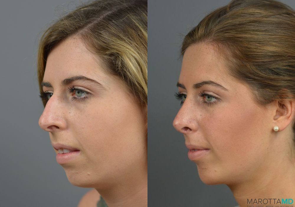 Rhinoplasty - Thumbnail 4