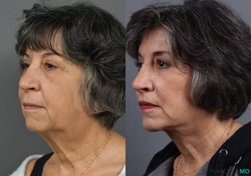 Before and after Chin Implant case 7027 - Angle 4